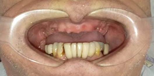 ANTES. INSTALACIÓN DE 6 IMPLANTES